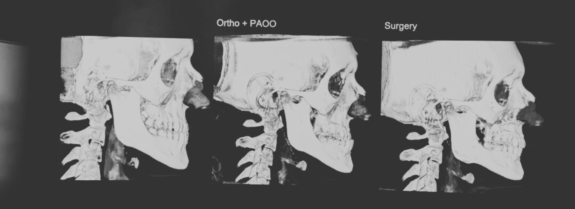 Rigenerazione-ossea-radiografia